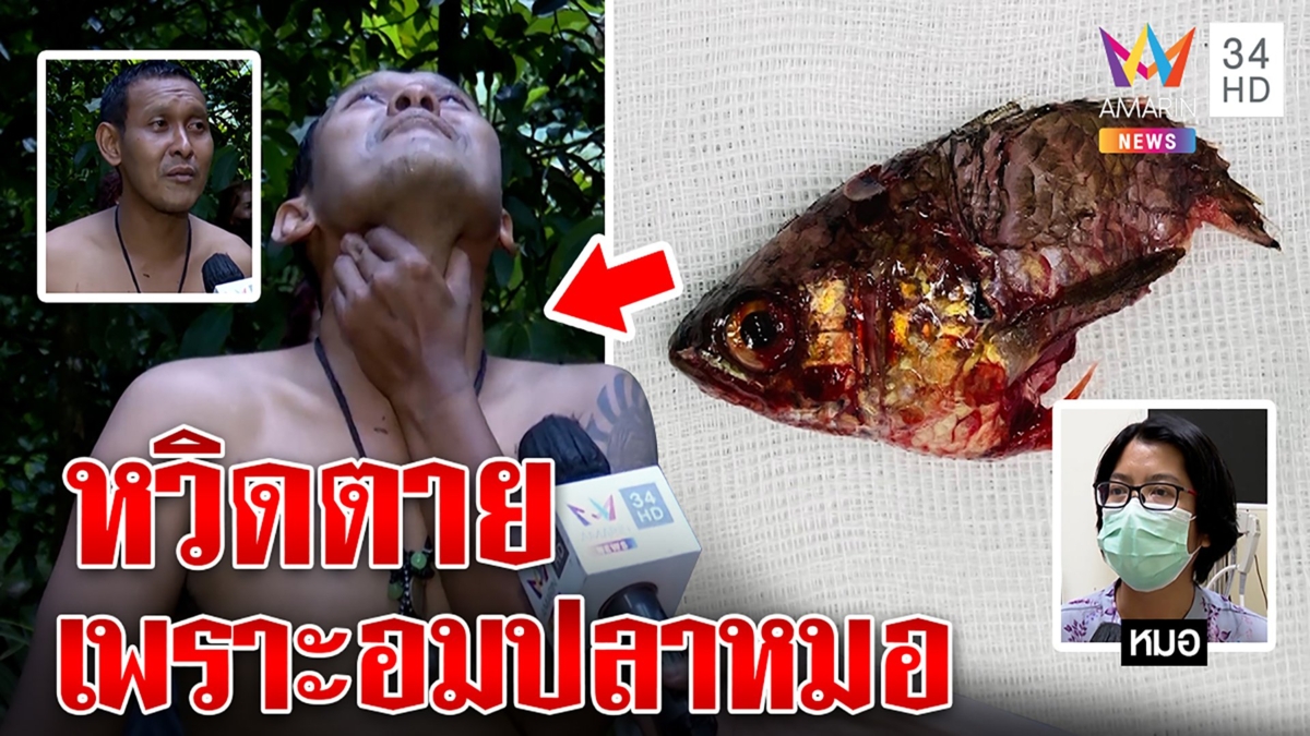 เปิดใจหนุ่มงับปลาหมอลื่นลงคอ ล็อกกระเดือกทำรอด หมอรับงานหินคีบผ่านหลอดลมหวิดตาย