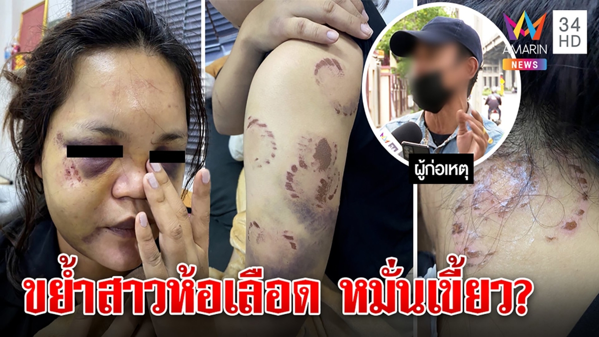 ล่าจากไลฟ์! หนุ่มป่วยจิตหมั่นเขี้ยวงับแขน-คอแฟน ทิ้งรอยรักฝังลึก สาวผวาขอตัดขาด