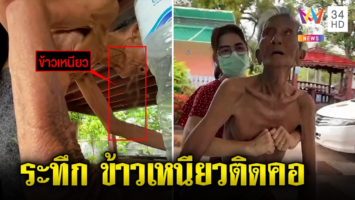 ตา 90 กลืนข้าวเหนียวติดคอหวิดดับ นักข่าวช่วยกระทุ้งทัน หมอเผยมาช้าอาจตาย