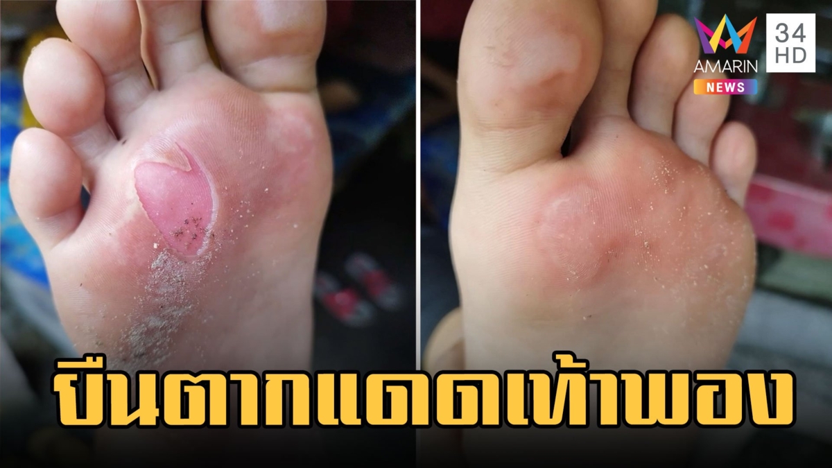 ผู้ปกครองโวย ครูให้ นร.ถอดรองเท้ายืนตากแดดจนเท้าพอง