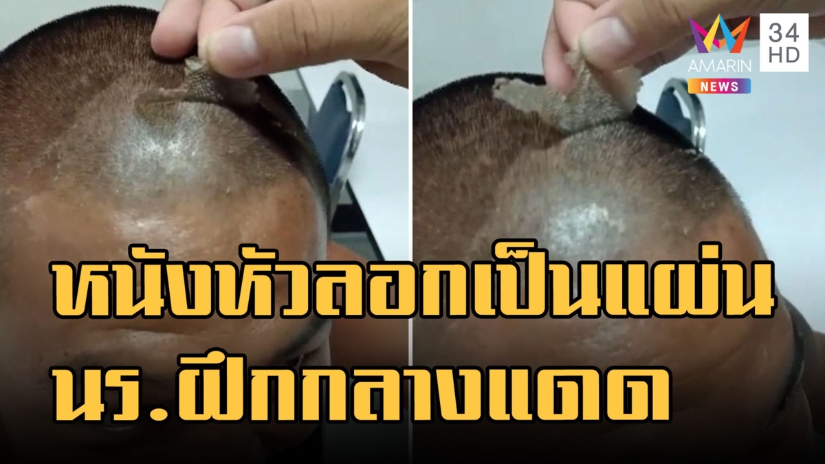แดดร้อนจัด! นักเรียนนายสิบฝึกตากแดด จนหนังหัวถลอกดึงออกเป็นแผ่น