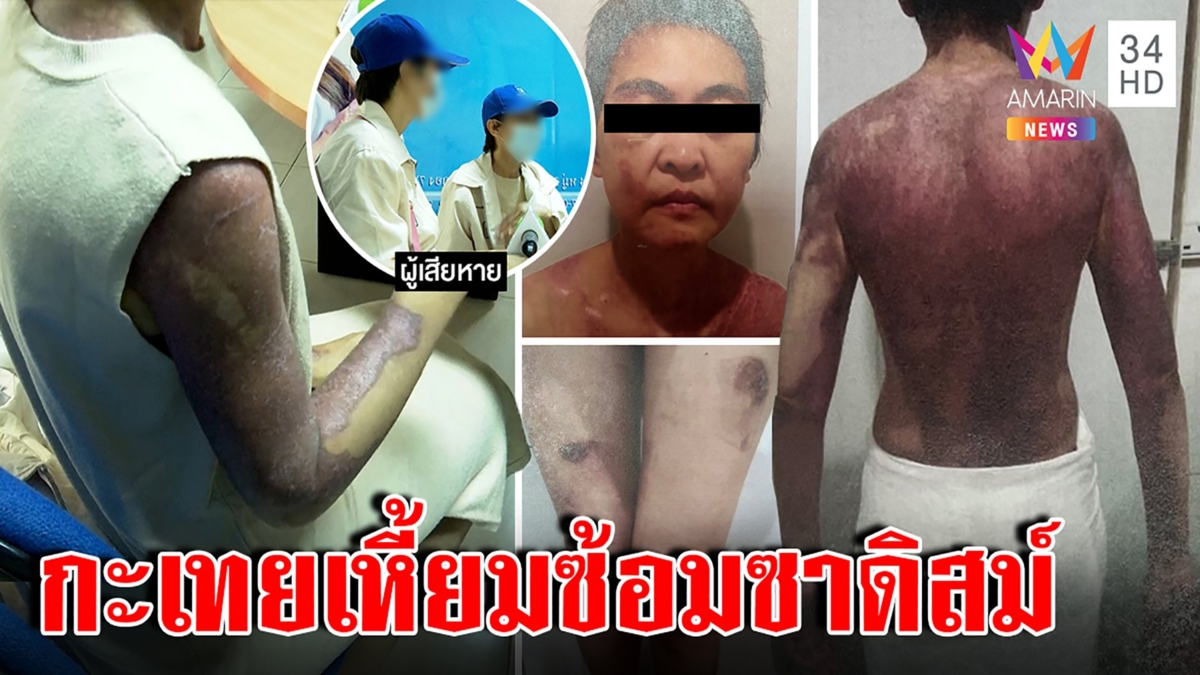 โคตรซาดิสม์! เหยื่อฮารุแฉโดนเตารีดนาบ เสี้ยมลูกชังแม่ เผยเหตุ 3 ปีไม่หนี