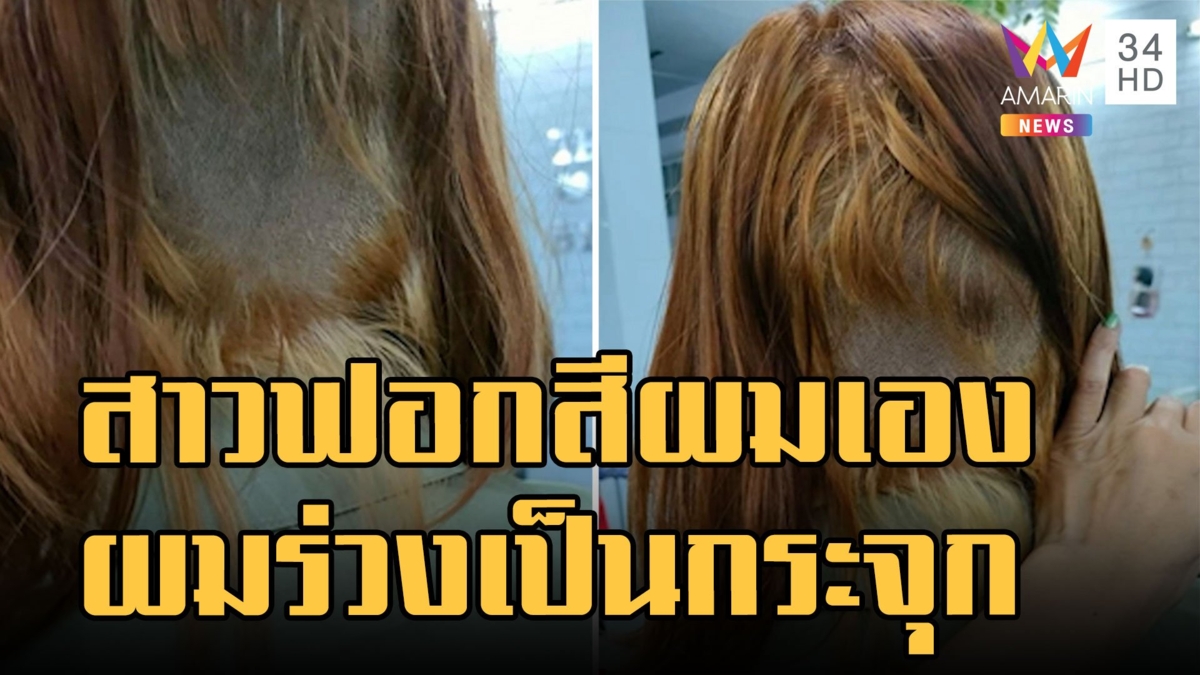 สาวกัดสีผมตัวเองผมหายครึ่งหัว หนังศีรษะเป็นแผล