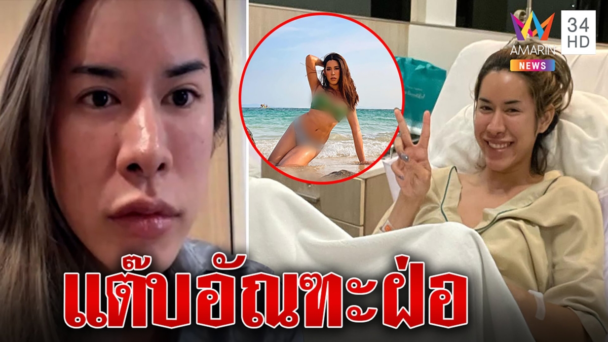อุทาหรณ์สาวสองแต๊บเก็บทรงเส้นเลือดเลี้ยงอัณฑะตีบทำบวมเท่าไข่ไก่ หมอสั่งตัดทิ้ง