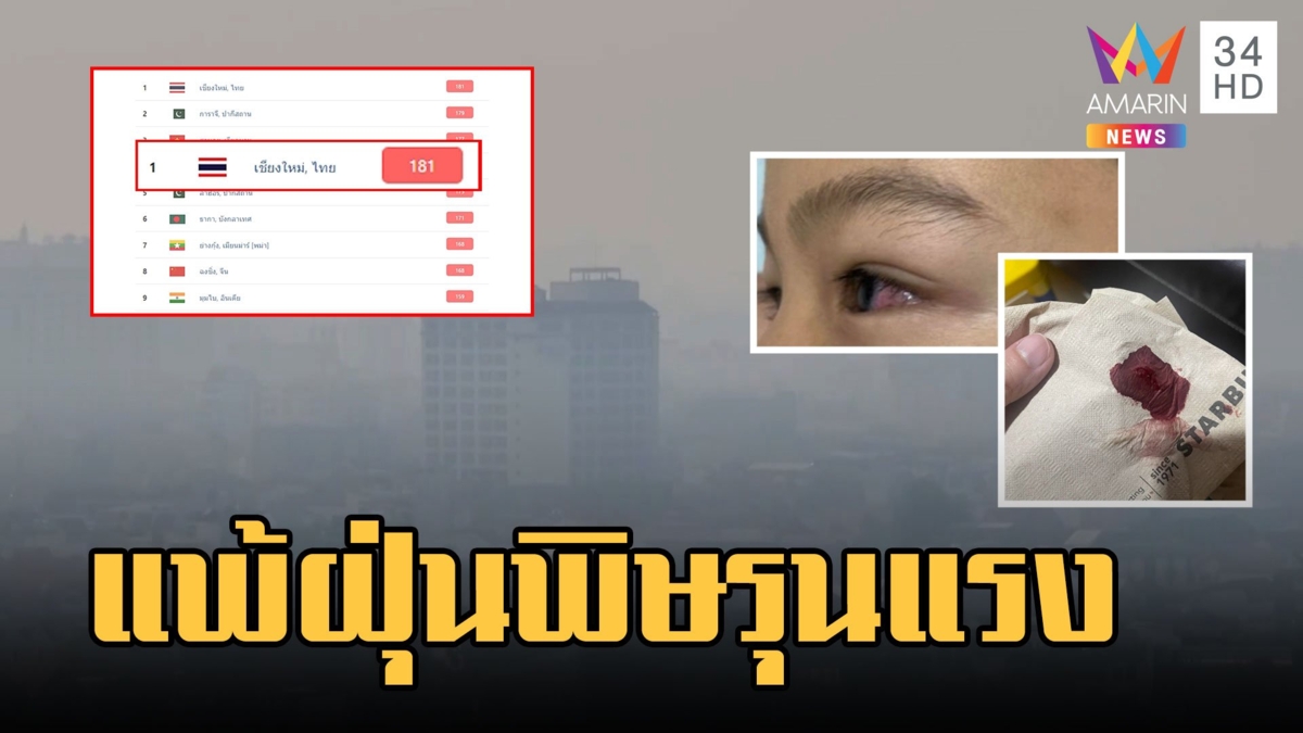 ค่าฝุ่น PM 2.5 เชียงใหม่พุ่ง สาวแพ้ฝุ่นเลือดกำเดาไหล-ตาแดง