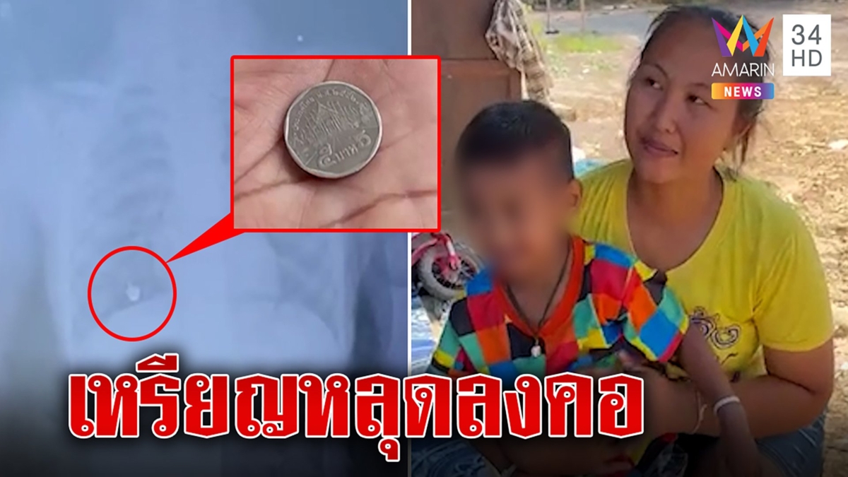 อุทาหรณ์! หนูน้อย 5 ขวบอมเหรียญ 5 หลุดลงคอเดชะบุญหมอช่วยได้ แม่ห่วงริบเงินเรียบ