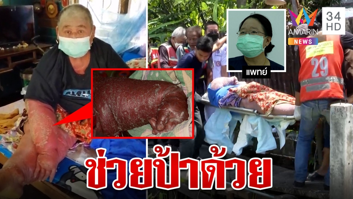 วอนช่วยคุณป้าสะเก็ดเงิน หนัก 140 เจ็บปวดเกินจะทน