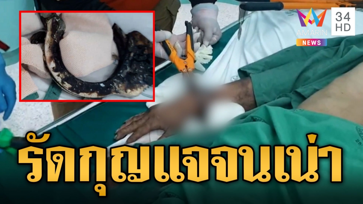 รุดช่วยชายป่วยจิต ใช้กุญแจมือสวมแขนแน่นจนเน่า
