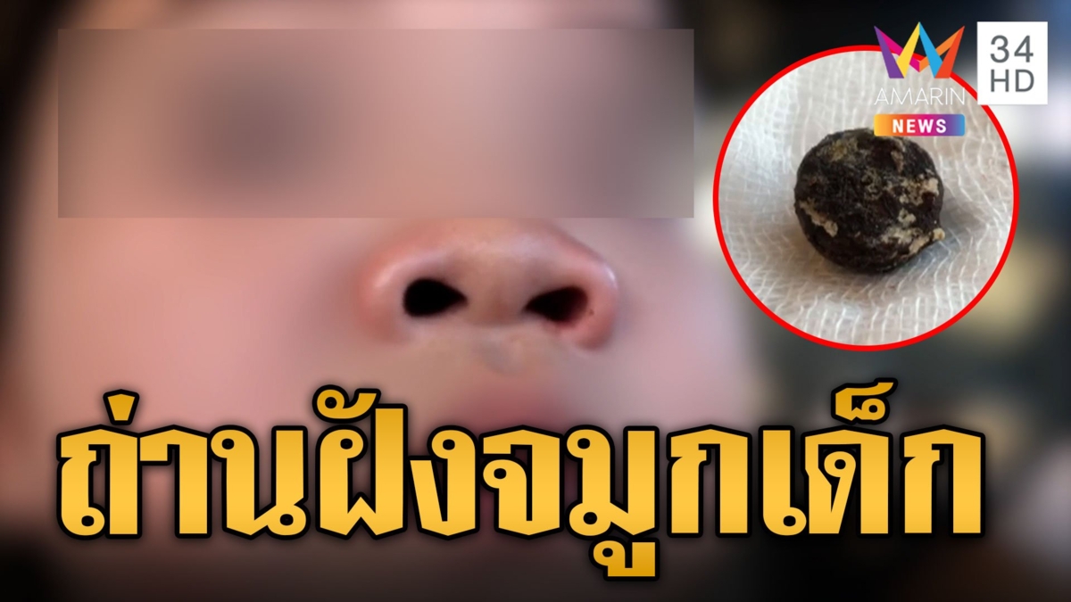 เด็กหญิง 3 ขวบป่วยน้ำมูกไหล รักษา 2 ปีไม่หาย ทรมานถ่านอยู่ในจมูก