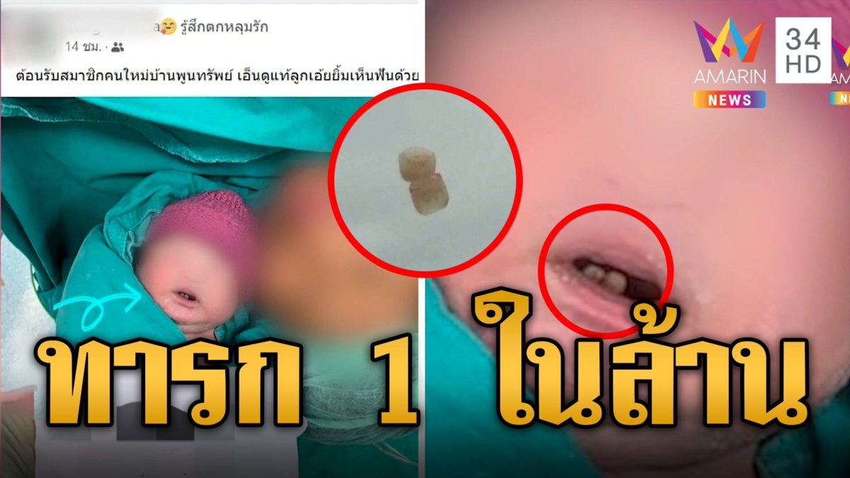 เด็กทารกเกิดมามีฟัน 2 ซี่เลย หมอต้องถอนออกกลัวกัดนมแม่