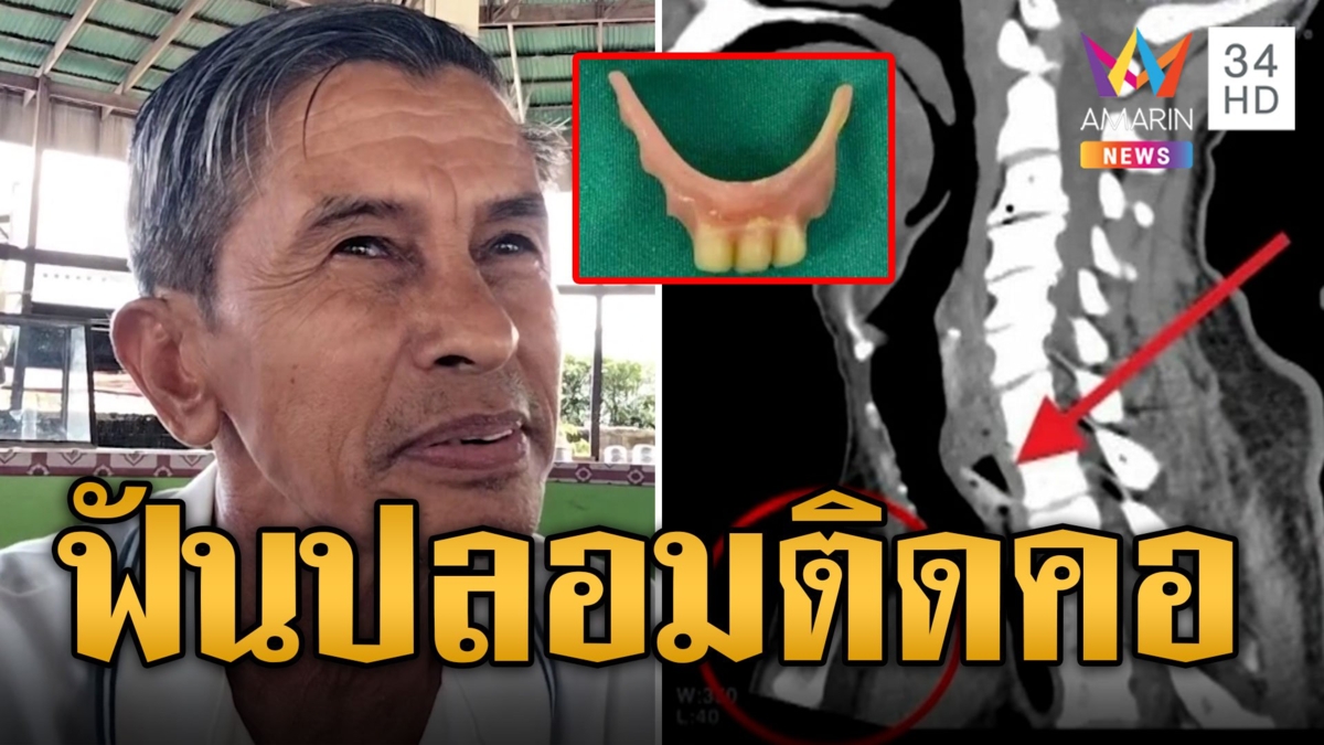 อุทาหรณ์! ฟันปลอมหลุดติดคอครูบำนาญ คิดว่าเป็นเศษอาหาร ผวาไม่กล้าใส่อีก