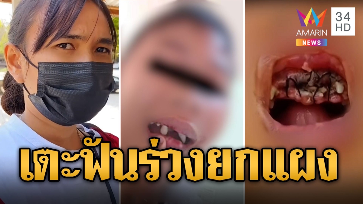 สงสารเลย! เด็ก ม.1 เตะปาก ป.5 ฟันหน้าหักยกแผง 4 ซี่ ค่ารักษาเป็นแสน