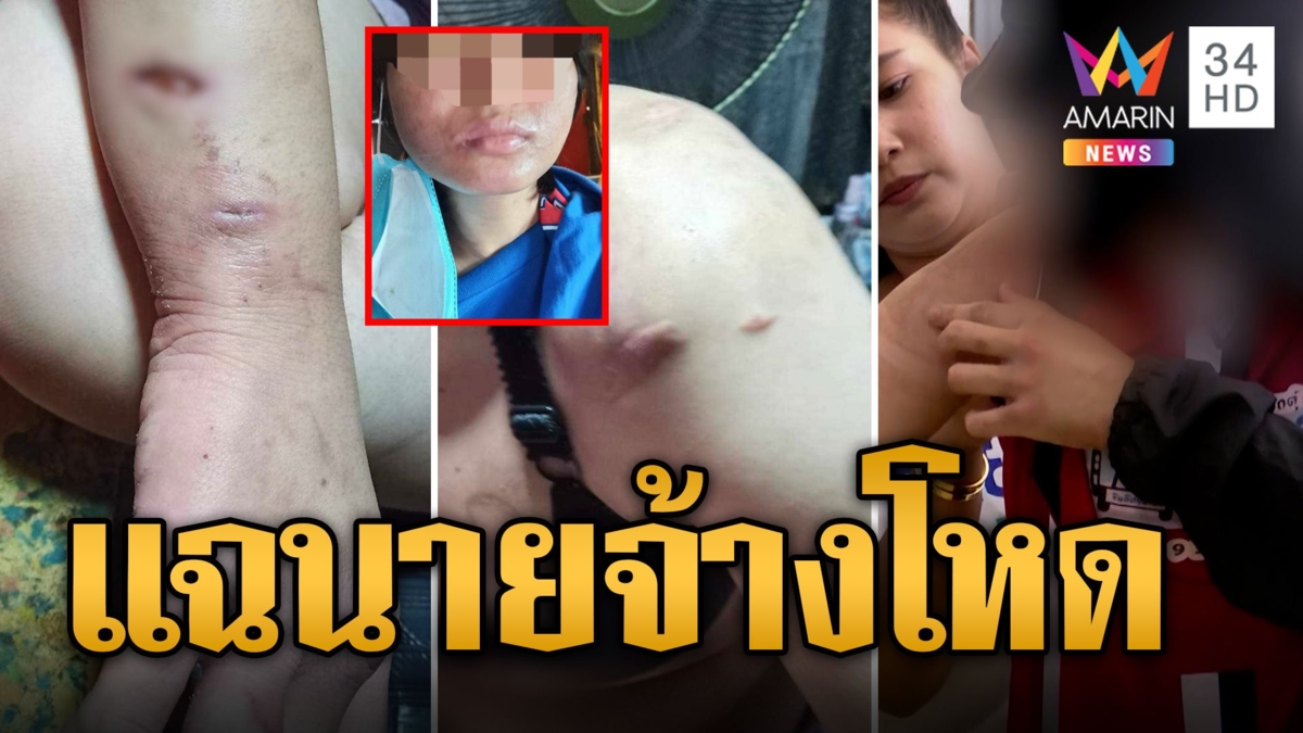 ลูกจ้างแฉผัวเมียนายจ้างโหด ซ้อมน่วมโหดจุดไฟเผา-ทุบตีเกือบพิการ