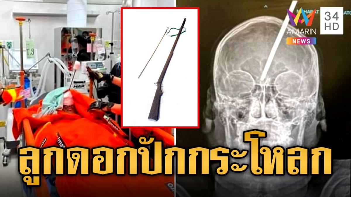 สยอง! ลูกดอกยิงแสกหน้าเด็ก 14 ปักลึกถึงสมอง