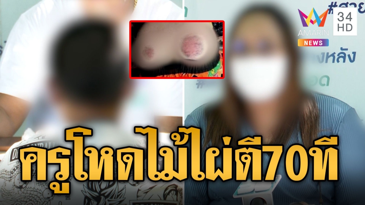 ครูภาษาไทยโหดตีนักเรียน 70 ทีตูดบวม ทำการบ้านไม่เสร็จ 70 หน้า ไข้ขึ้นเข้า รพ.ผวาไม่กล้าไปเรียน