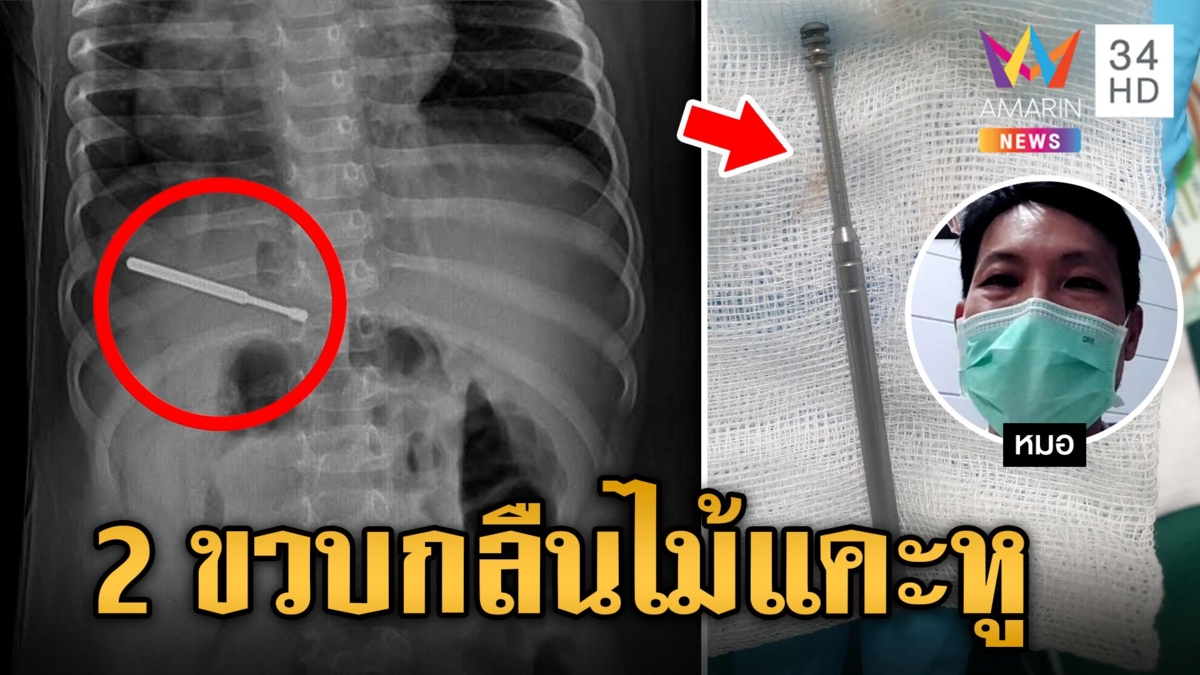 2 ขวบกลืนไม้แคะหู ผู้ปกครองพึงตระหนัก เด็กวัยนี้เห็นอะไรเอาเข้าปากหมด