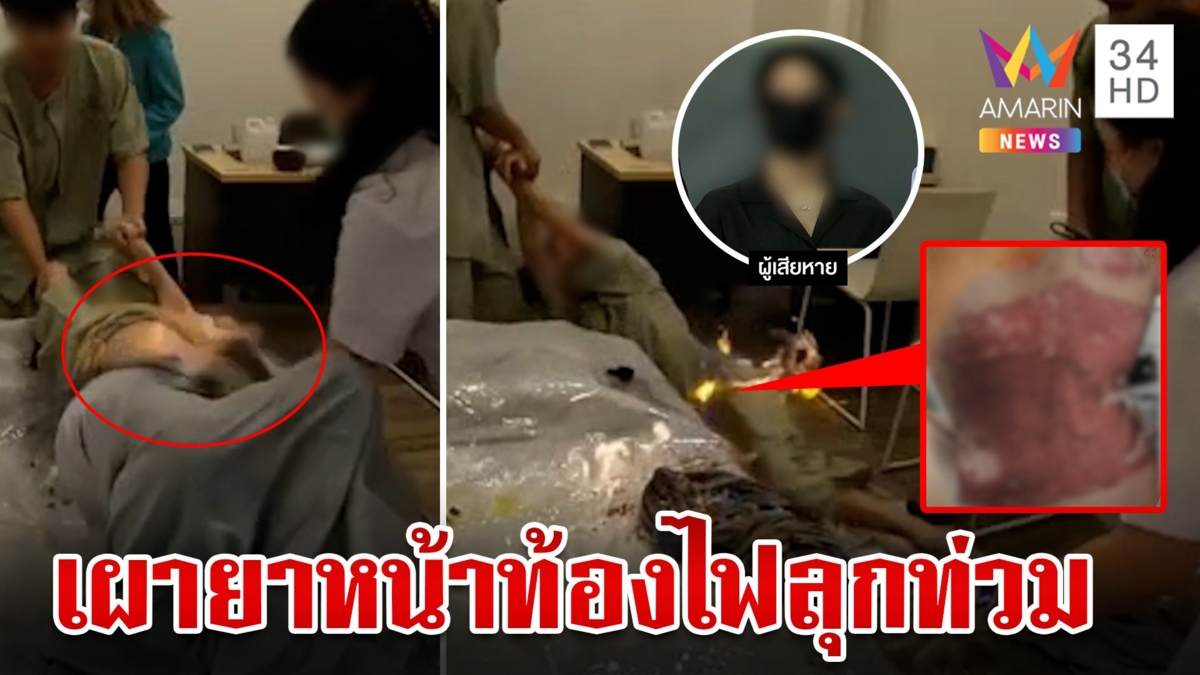 สยองเผายาหน้าท้องไฟคลอกร่างเน็ตไอดอลสาวสาหัส คลินิกเมินเยียวยา หมอหนีไปต่างประเทศแล้ว