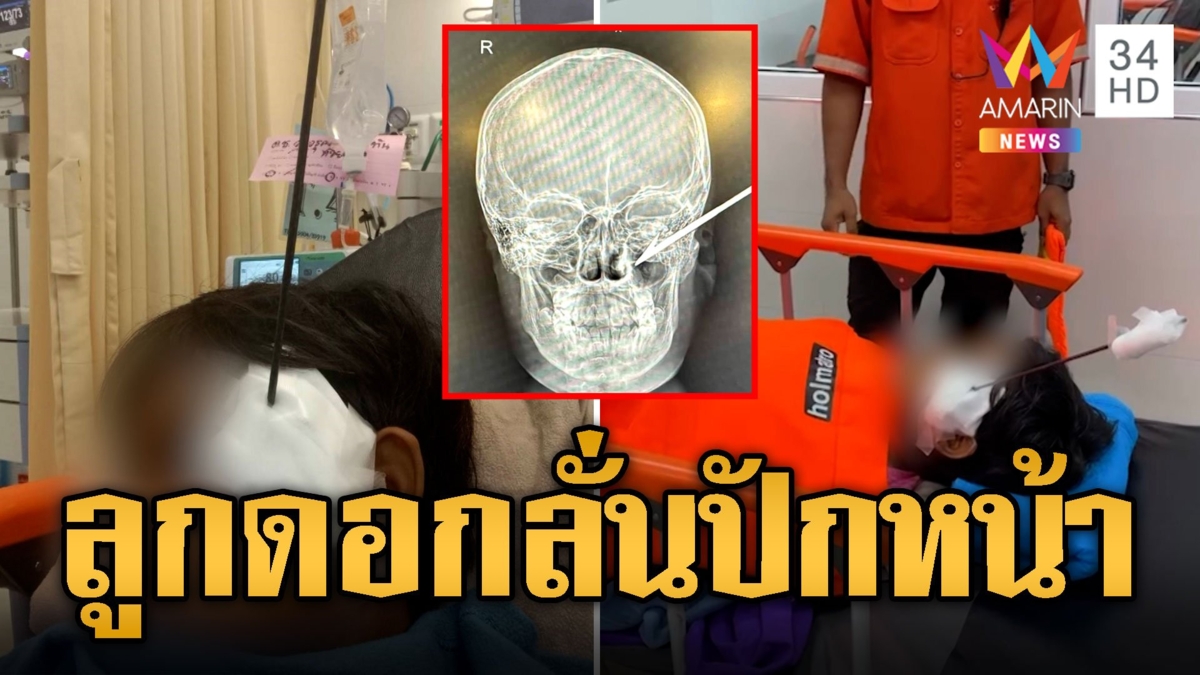 เสียวไส้! เด็ก 13 เล่นปืนยิงหนู ลูกดอกลั่นปักหน้าหวิดตาบอด