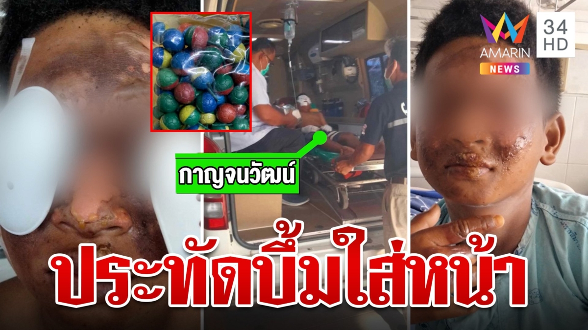 ปีใหม่สยอง! เด็ก 11 ขวบแงะประทัดตูมใส่หน้าเหวอะ ตาหวิดบอด