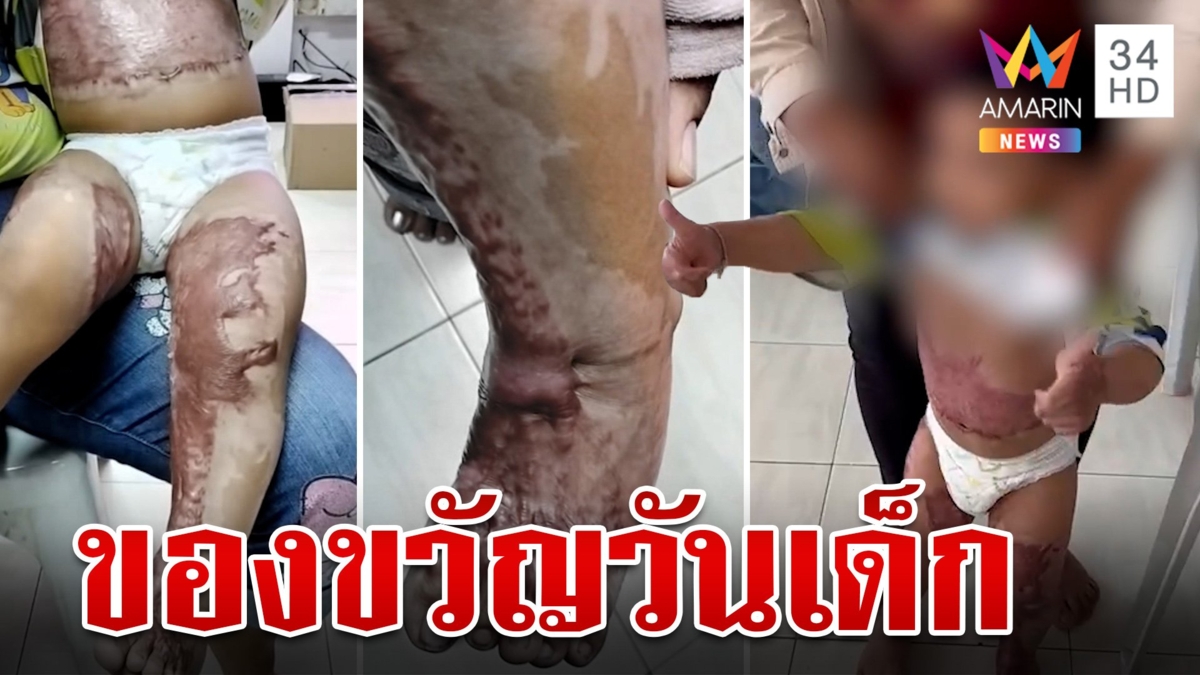 ของขวัญอันยิ่งใหญ่ "ปวีณา" ช่วยหนูน้อย 2 ขวบ ถูกน้ำมันลวกทั้งตัว