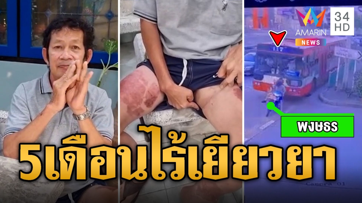 พ่อลูกโวยถูกรถเมล์ชน 5 เดือนไร้เยียวยา จ่ายแค่หมื่นเดียว ใช้ชีวิตลำบาก