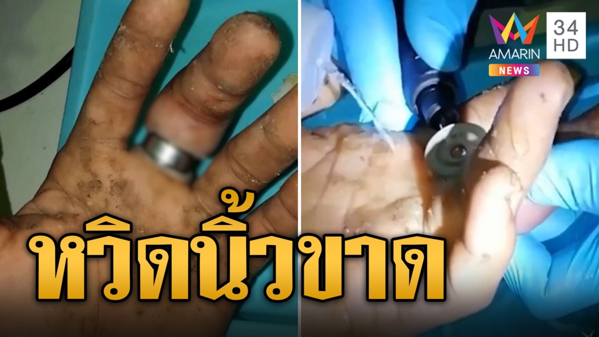 หนุ่มหวิดนิ้วขาด แหวนรัดนาน 5 วันกู้ภัยเร่งช่วย