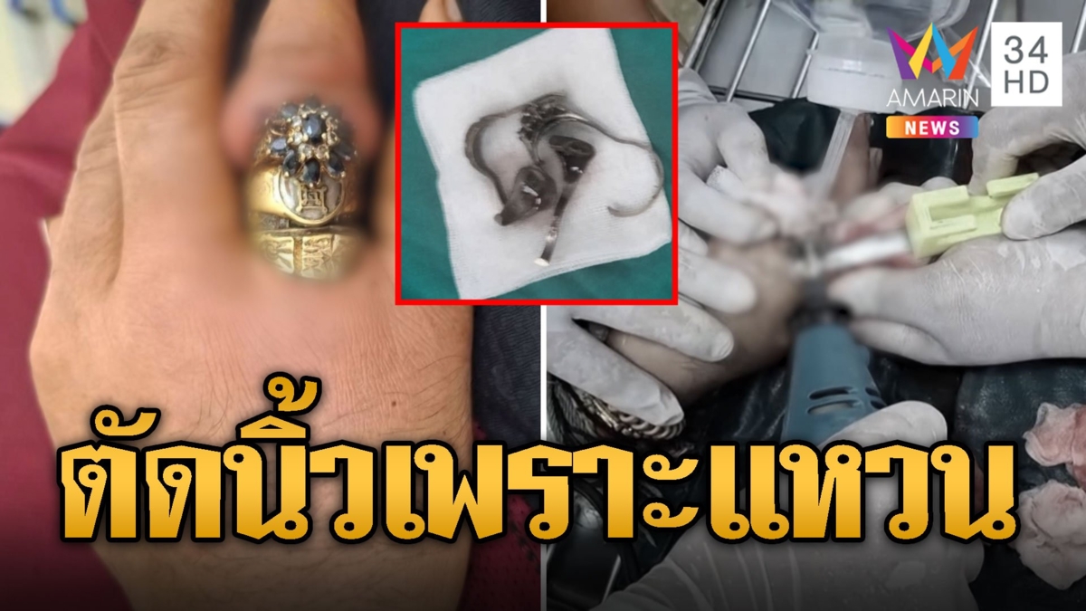 หนุ่มจำใจตัดนิ้วทิ้ง สวมแหวน 4 วงรัดจนเน่า