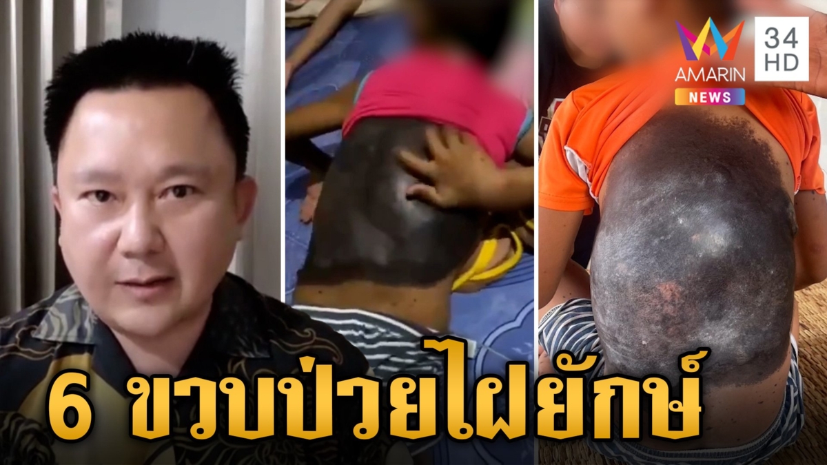 รุดช่วย 6 ขวบป่วยไฝยักษ์คันทั้งตัว หมอเผยต้นตอเพราะอะไรจึงเป็นโรคนี้