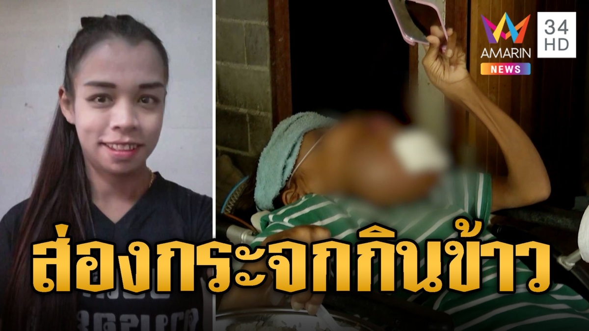 สาวสู้ชีวิต ป่วยโรคไตซ้ำเป็นมะเร็งปาก ต้องส่องกระจกกินข้าว