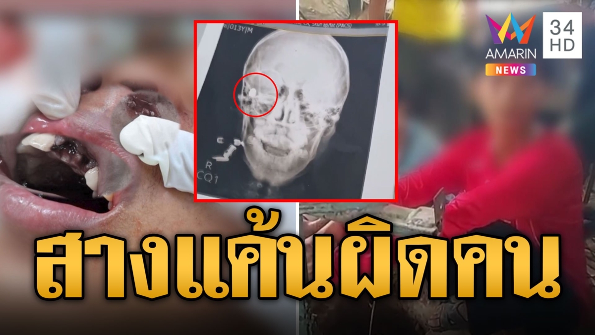 โจ๋สางแค้น ยิงผิดตัวทะลุแก้มเด็ก 13 กระสุนฝังคอ