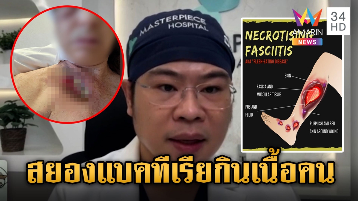 รู้จักโรค "แบคทีเรียกินเนื้อคน" ผวาติดเชื้อหนักถึงขั้นเสียชีวิต