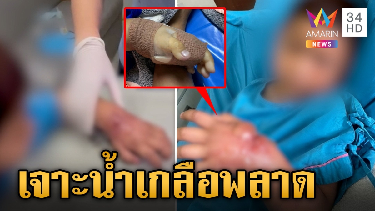 แม่ร้อง รพ.เจาะน้ำเกลือพลาด ทำลูกมือพองคล้ายน้ำร้อนลวก