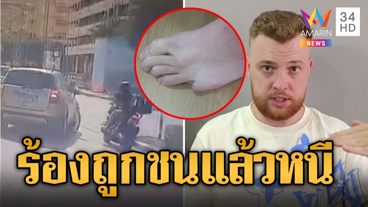 หนุ่มรัสเซียร้อง ถูกรถชนนิ้วขาด ตร.ปล่อยคู่กรณีหนีคดีไม่คืบ