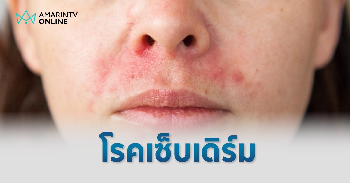 ผื่นแดง เป็นขุย แสบคัน ระวังอาจเป็น "โรคเซ็บเดิร์ม"