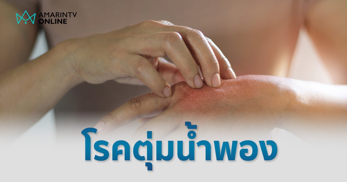 "โรคตุ่มน้ำพอง" สาเหตุเกิดจากอะไร รักษาหายขาดได้หรือไม่