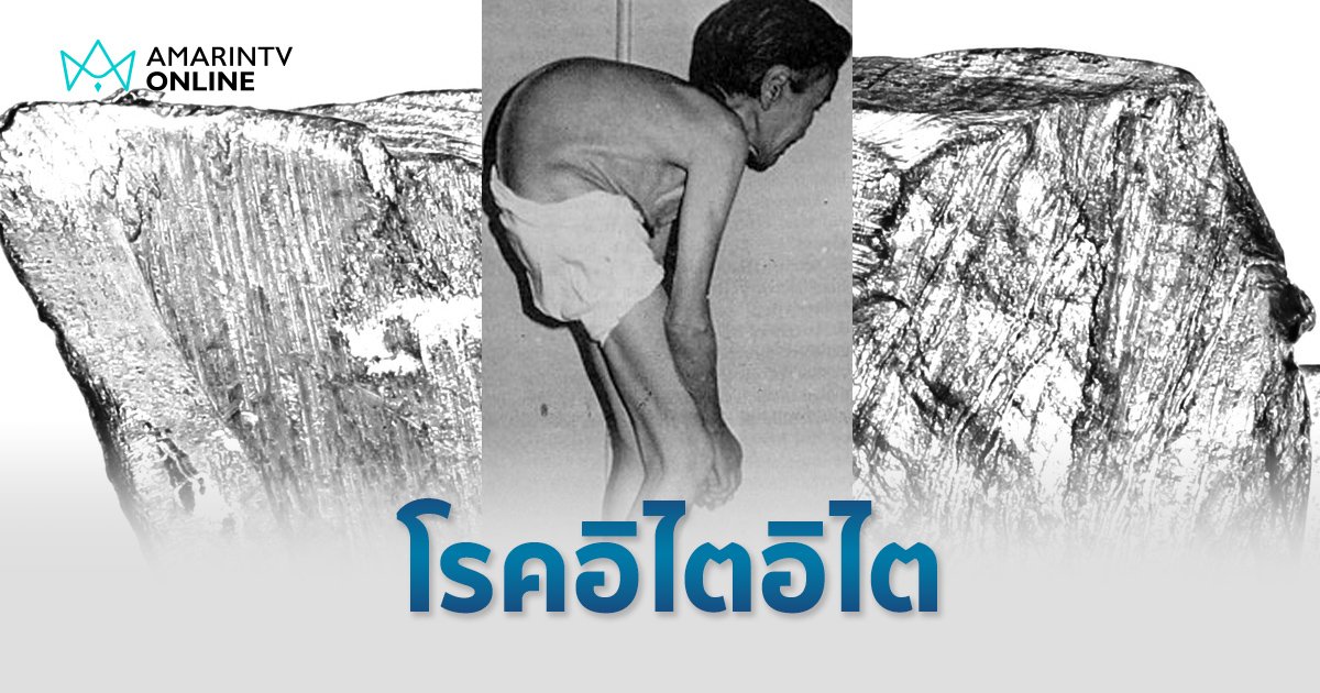 โรคอิไตอิไต อันตรายจากสารแคดเมียม รุนแรงทำพิการจนถึงขั้นเสียชีวิต