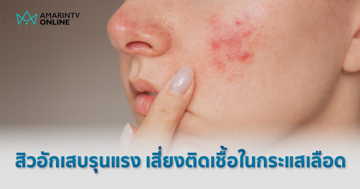 รู้จัก Acne Conglobata สิวอักเสบรุนแรง เสี่ยงติดเชื้อในกระแสเลือด