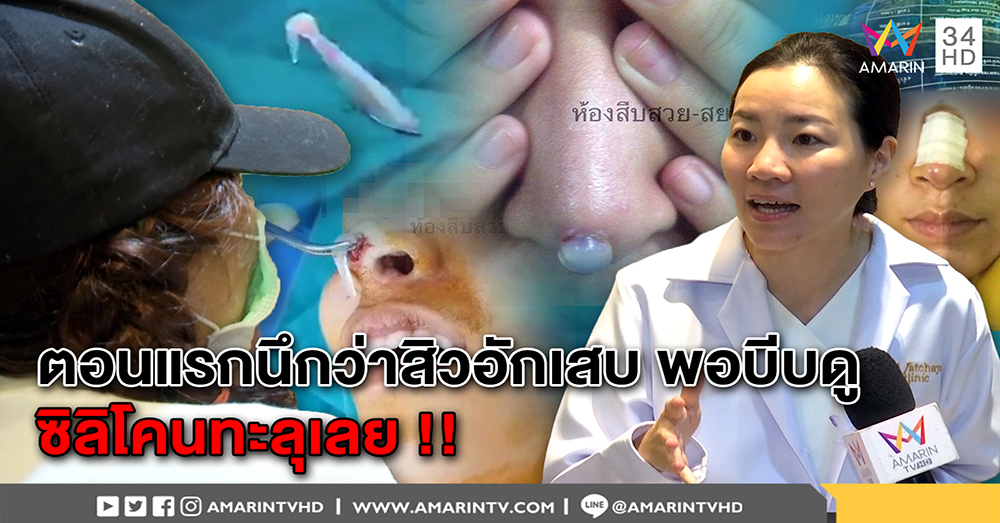 สาวซิลิโคนทะลุดั้ง เผยภาพสุดเจ็บผ่าหนอง ถูกหมอยัดแท่งบิ๊กไซด์เข้ารู ไม่ดูขนาดจมูก (คลิป)
