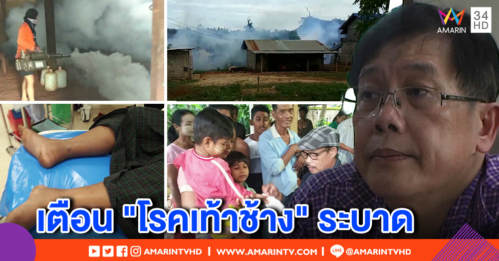 พบผู้ป่วยโรคเท้าช้าง ผอ.รพ.แม่สอด ชี้รุนแรงในรอบ 3 ปี แนะนอนมุ้ง กำจัดแหล่งเพาะพันธุ์ยุง