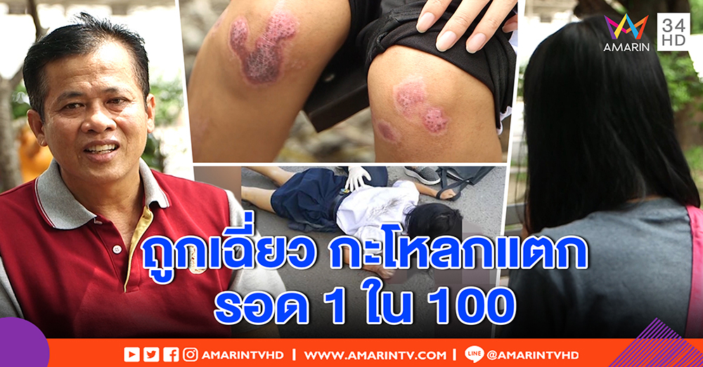 เปิดใจ นร.16 ถูกเมล์ 113 เฉี่ยวล้ม กะโหลกแตก ออก รพ. แล้ว ตาเข ปากเบี้ยว โต้ขับมือเดียว (คลิป)