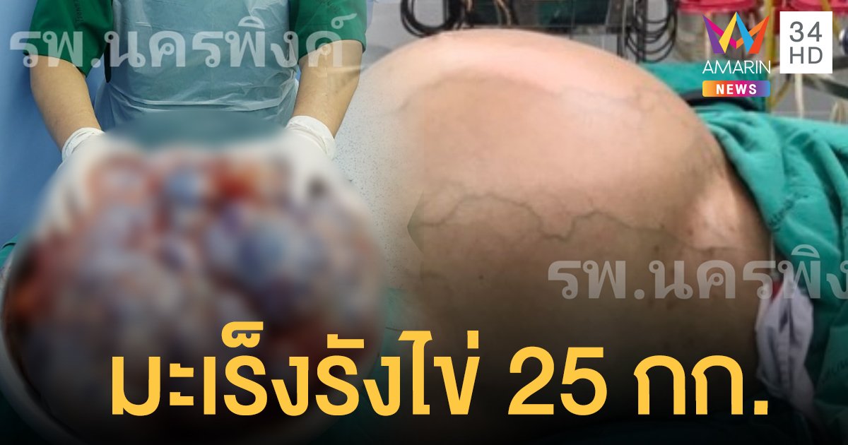 ชื่นชม! แพทย์เชียงใหม่ ผ่าตัด "มะเร็งรังไข่" ยักษ์หนัก 25 กก.