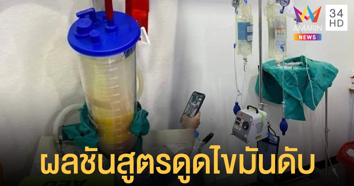 เผยผลชันสูตรศพ น้องสาวอดีตรองผู้ว่าฯ เมืองคอน เสียชีวิตหลังดูดไขมัน