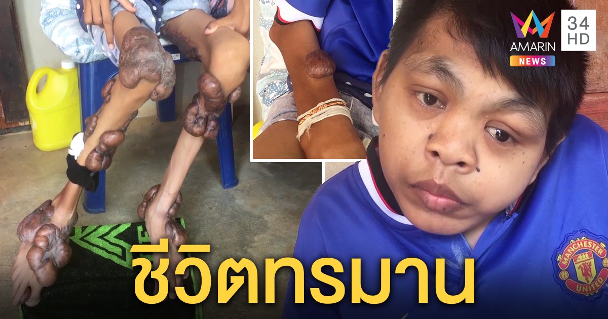 เปิดใจหนุ่มป่วยมะเร็งเนื้องอกลามขา 2 ข้าง ทรมาน 17 ปี ท้อค่ายาวอนคนใจบุญช่วย (คลิป)