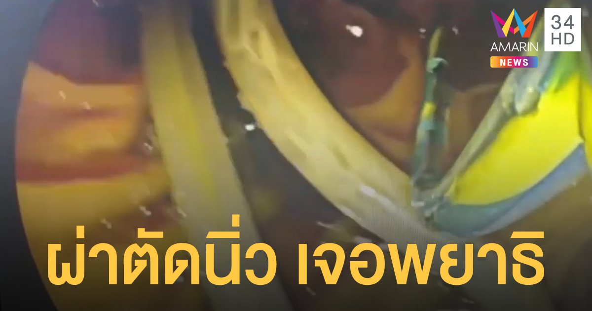 ช็อก! หมอผ่านิ่วคนไข้เจอ พยาธิไส้เดือน ในท้อง ตัวใหญ่ยาว