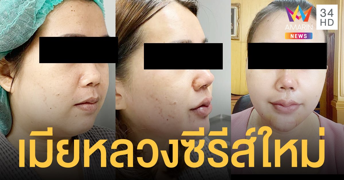 คลินิกเสริมความงาม เผยโฉมใหม่ เมียหลวงบุกงานแต่ง โมชุดใหญ่ เอาให้สวยจนตะลึง
