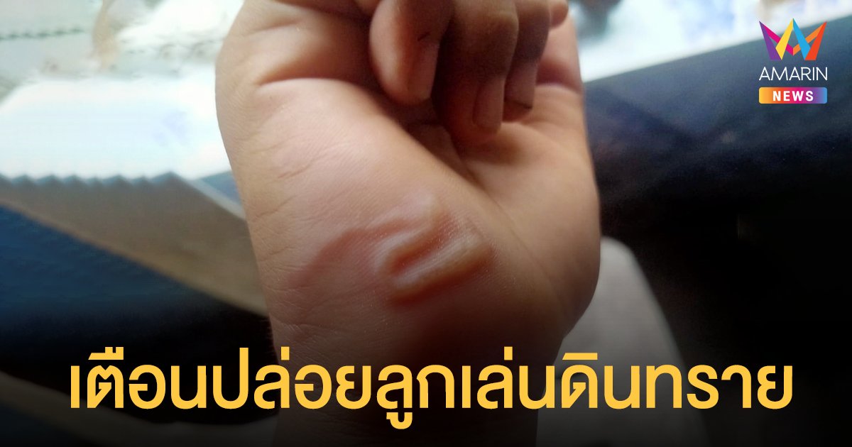 ระวัง! พยาธิปากขอ แม่โพสต์เตือนภัยลูกน้อย เพจดังชี้แฝงตัวในดินทรายที่มีอึหมา-แมว ปะปน