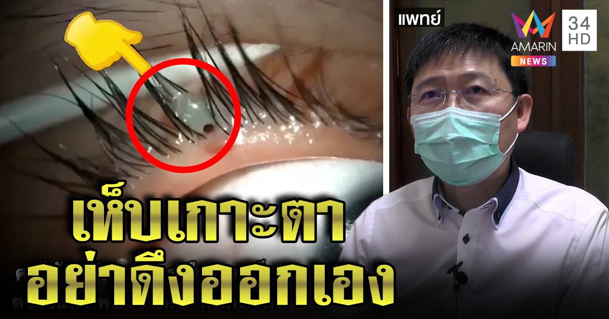 เห็บหมาเกาะเปลือกตาคน ดูดเลือดตัวบวมเป่ง “จักษุแพทย์” แนะอย่าดึงเองเสี่ยงติดเชื้อ (คลิป)