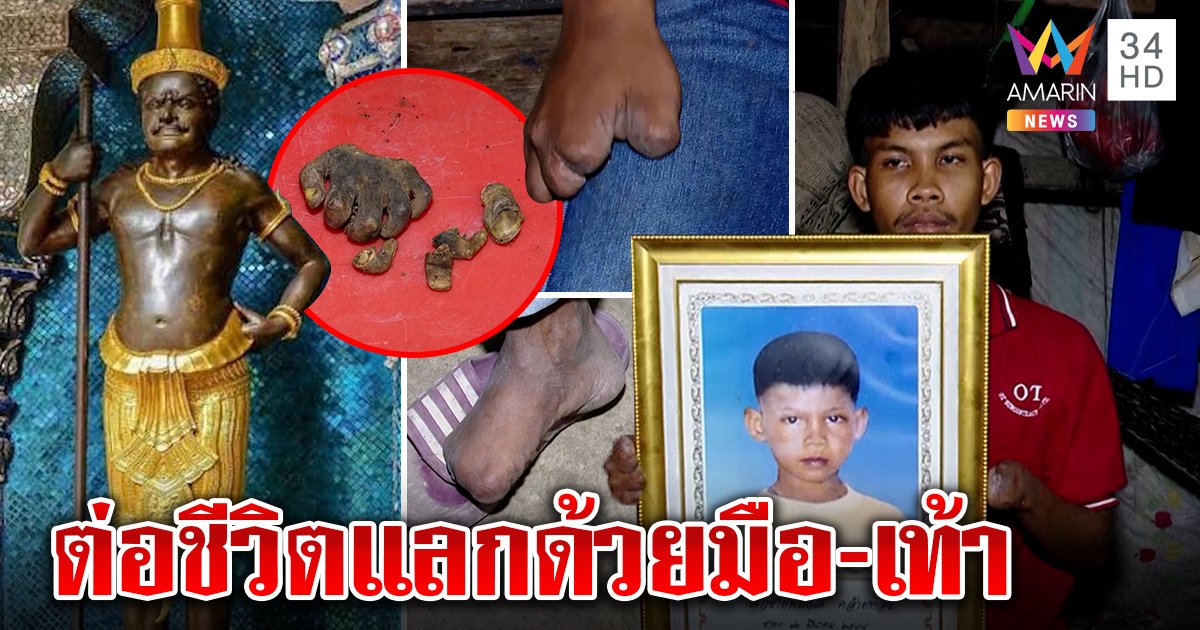 เปิดใจ "น้องจ่อย" ตายแล้วฟื้น ท้าวหิรัญชุบชีวิตแลกเสียนิ้วมือ - เท้า 10 ปีไม่มีป่วย (คลิป)