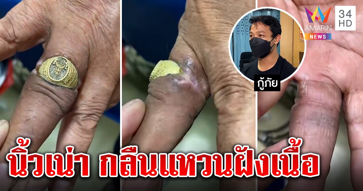 สยอง! กู้ภัยช่วยตาป่วยจิต “นิ้วกินแหวน” เจ็บจนเดินมาหาหมอ ต้องกรีดหนังนับชั่วโมง (ภาพ)