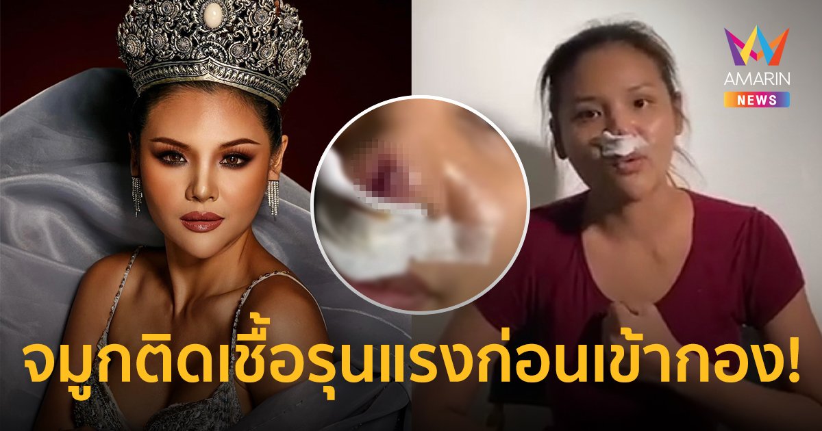 โชคชะตาเล่นตลก! "เกมส์ ปอรรัตน์" มิสแกรนด์สุรินทร์ 2022  จมูกติดเชื้อรุนแรงเกือบทะลุ!